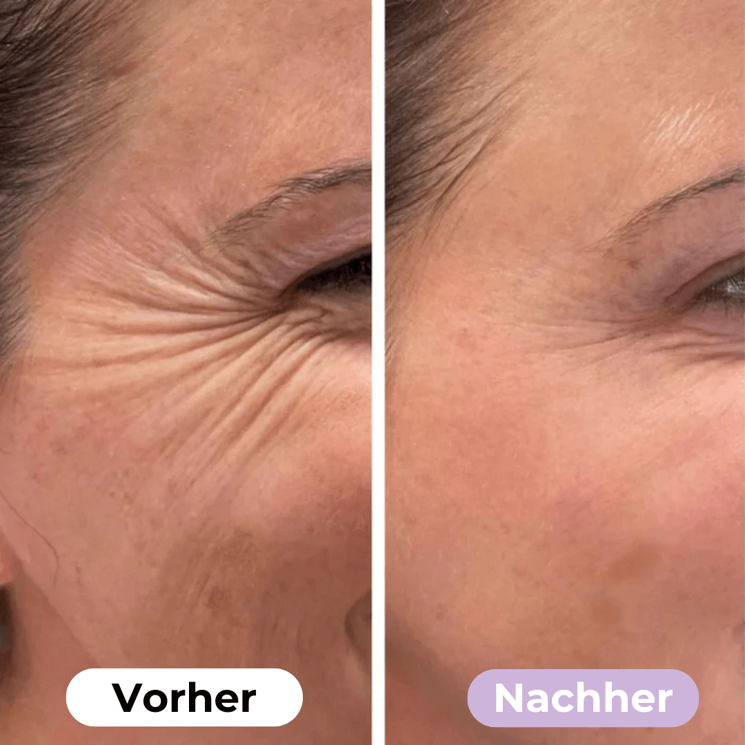 SmoothSkin™ Silikonplåster mot rynkor