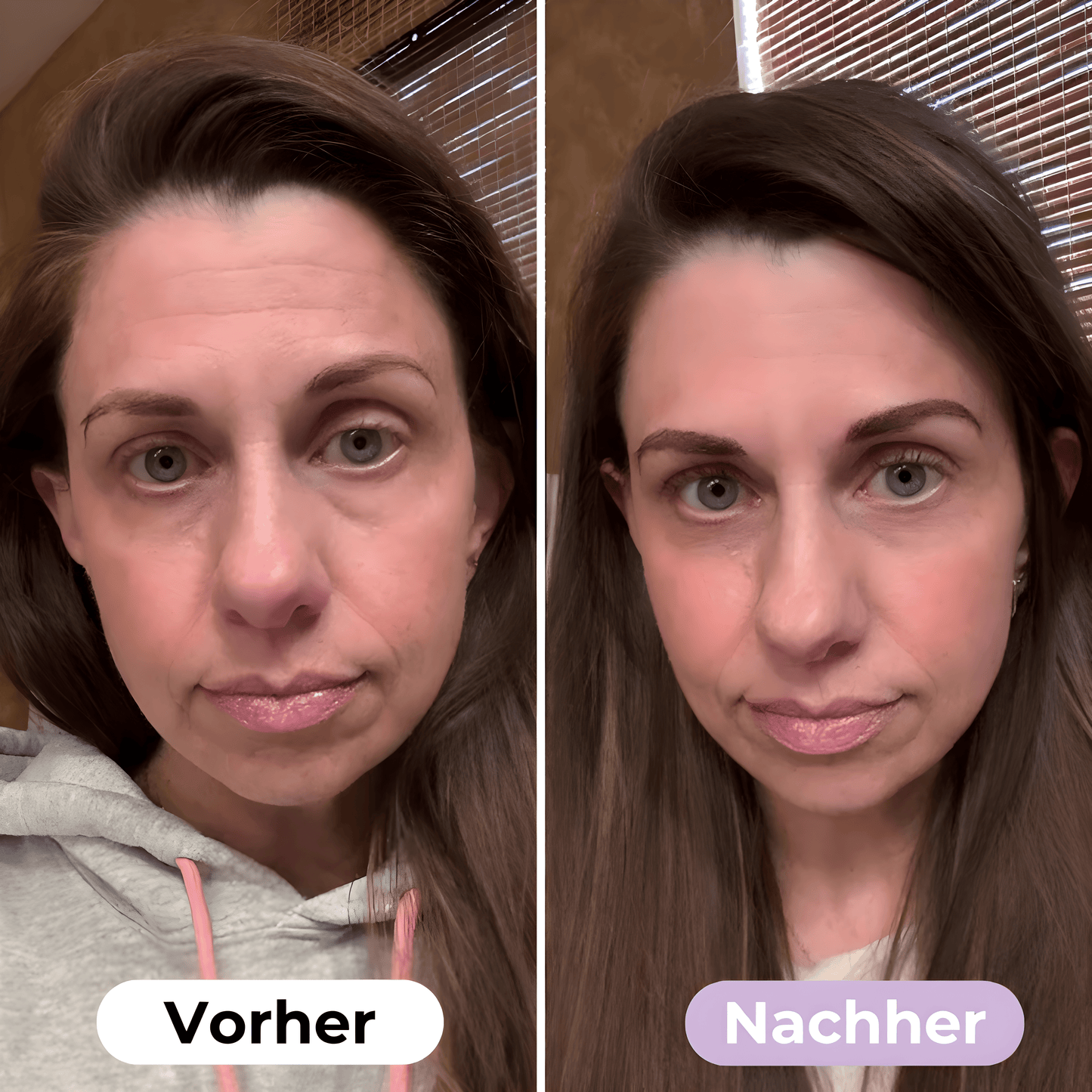 SmoothSkin™ Silikonplåster mot rynkor