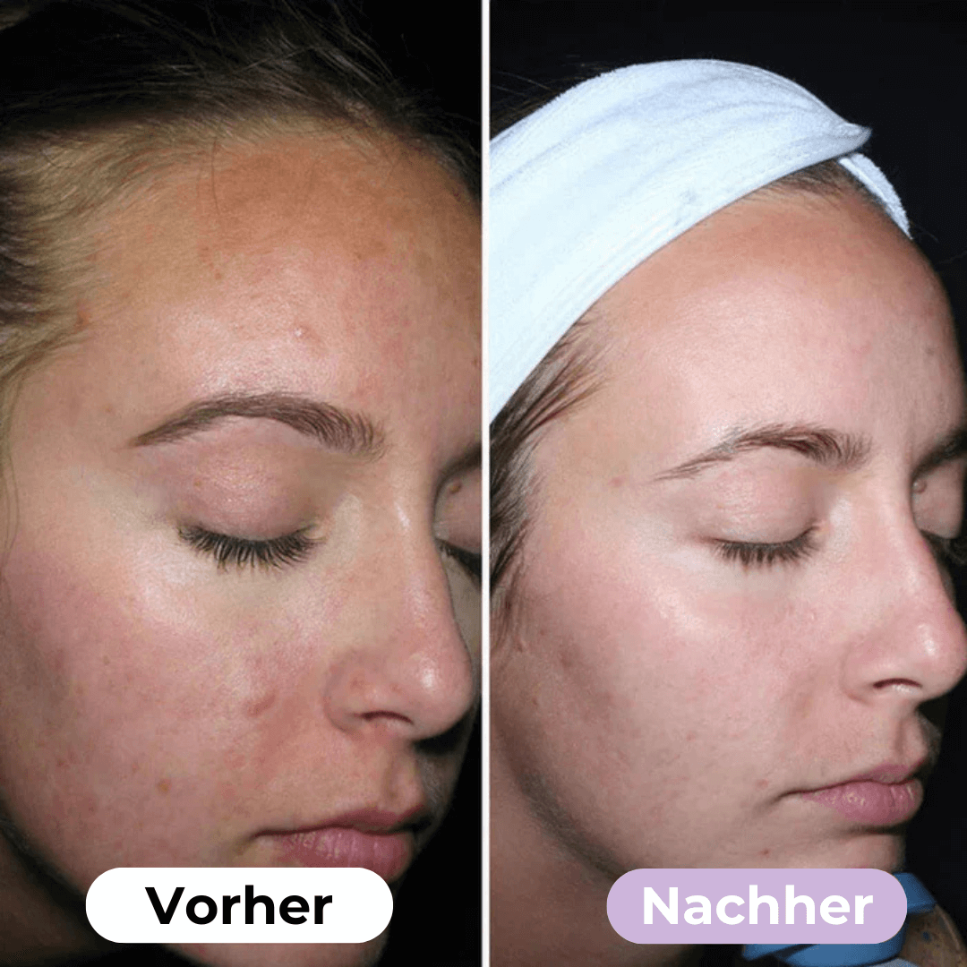 SmoothSkin™ Silikonplåster mot rynkor