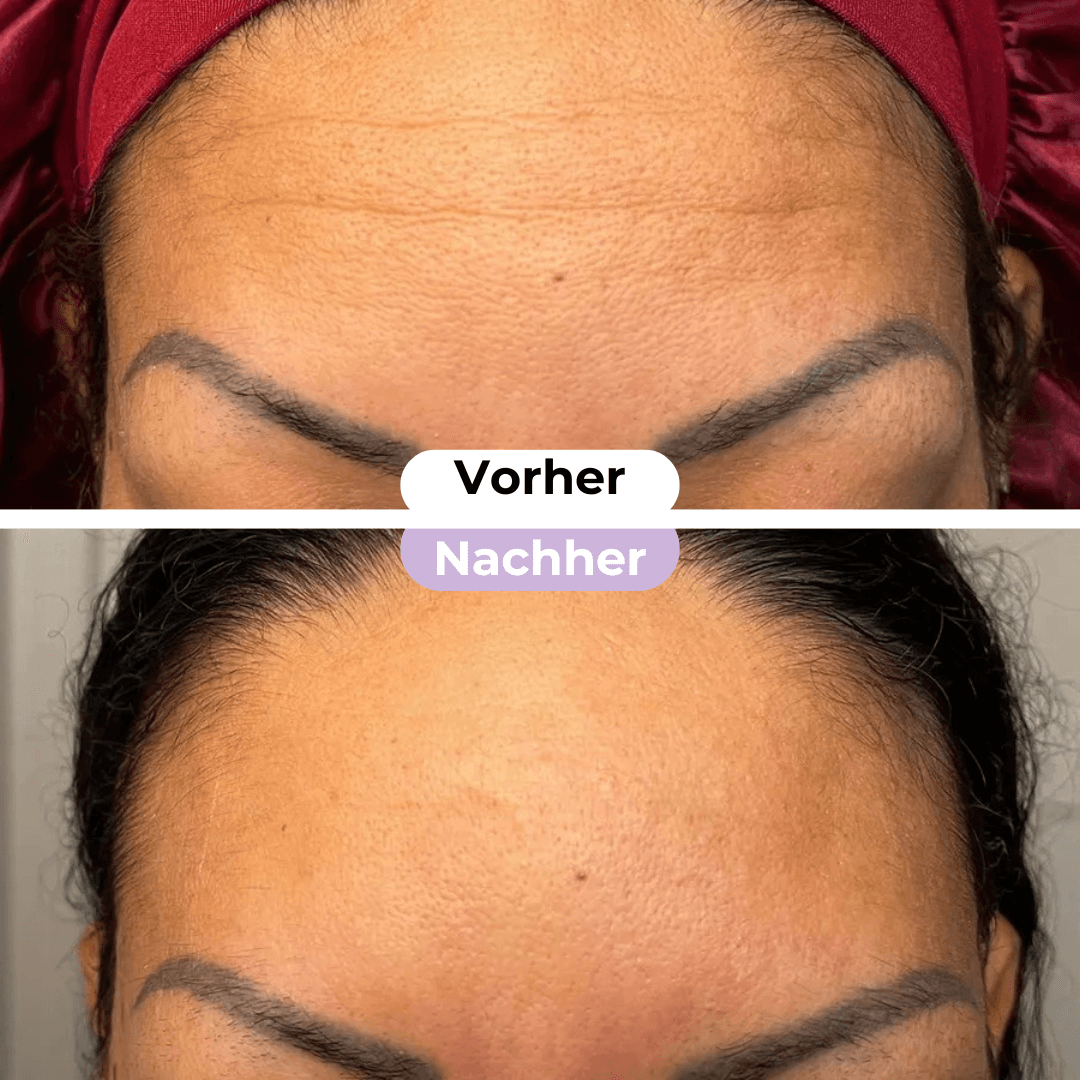 ScarRelief ™ | Ärrplåster i silikon