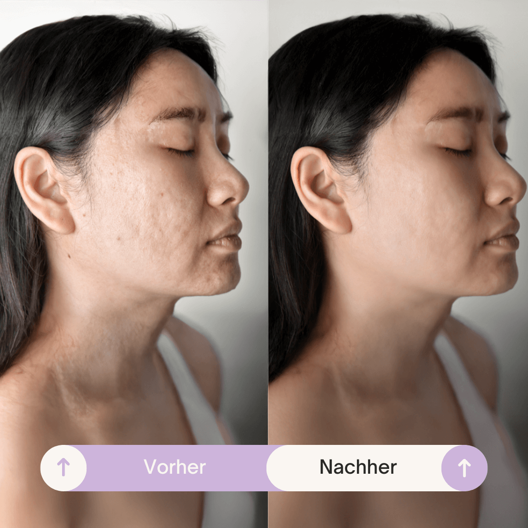 SmoothSkin™ Silikonplåster mot rynkor