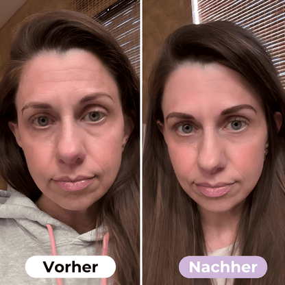 SmoothSkin™ Silikonplåster mot rynkor