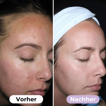 SmoothSkin™ Silikonplåster mot rynkor